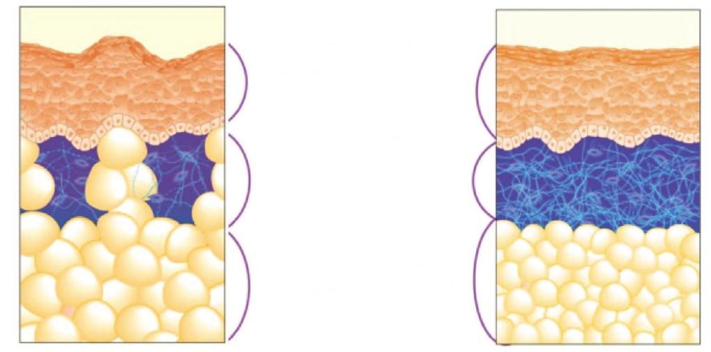 Pele com celulite Pele firme sem celulite 3 - Nível Epidérmico Estimula a regeneração da pele. 2 - Nível Dérmico: Limite da degradação de fibras da derme e infiltração de gordura.