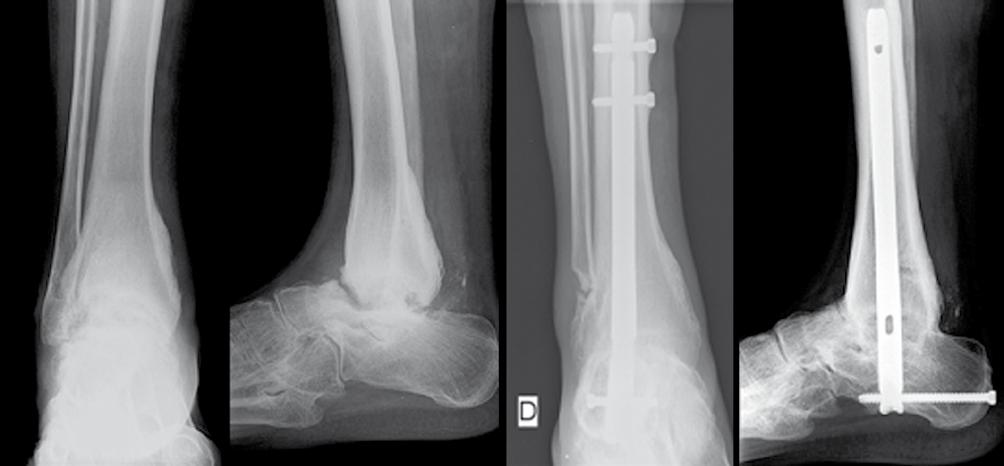 Radiologicamente apresentava necrose asséptica do talus. Submetido a artrodese tibio-talocalcâneana com cavilha (Figura 2).