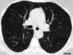 2 TOMOGRAFIA DE TÓRAX E TÉCNICA DE ALTA RESOLUÇÃO DOS PULMÕES Para maximizar os detalhes anatômicos pulmonares e