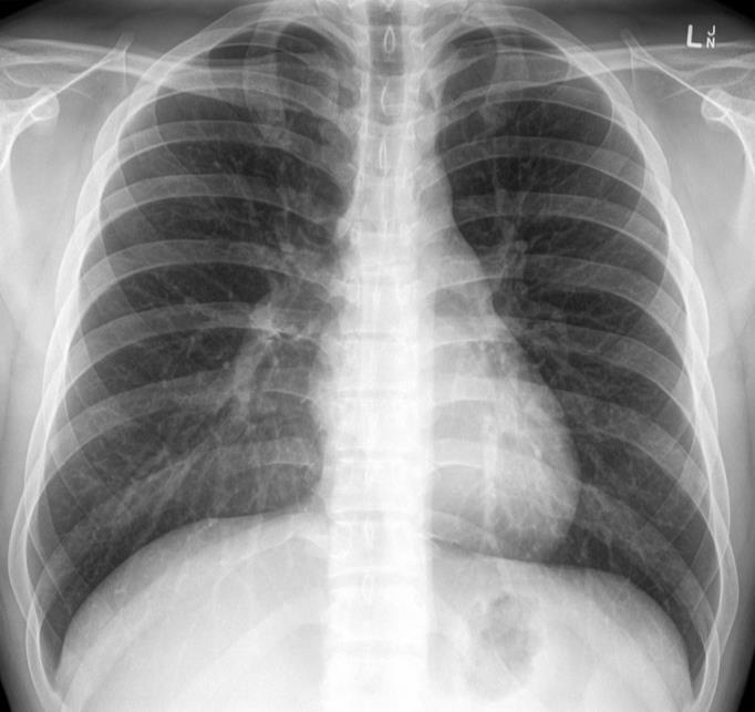 3 ANATOMIA LOBAR Radiografia convencional: ramificações das artérias e veias são o único ponto de observação do interstício