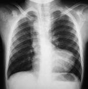 5 ENTENDENDO O MEDIASTINO (APARELHO CARDIOVASCULAR): Aumento ventricular direito (HAP / estenose de valva pulmonar