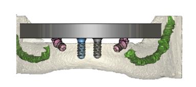 Os implantes foram modelizados tendo por base o implante comercial Straumann Standard Plus Tissue Level Roxolid Implant, Figura 1.