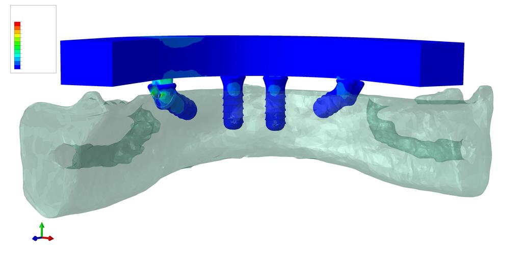 osteointegrados; conexão perfeita entre osso/implante/prótese; e movimento das mandíbulas limitado através da sua fixação a distal.