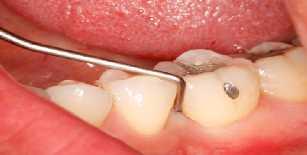 A lesão endo-periodontal é de origem polimicrobiana com características anaeróbicas, sendo que a microbiota da infecção endodôntica é menos complexa que a das infecções periodontais 12,13.