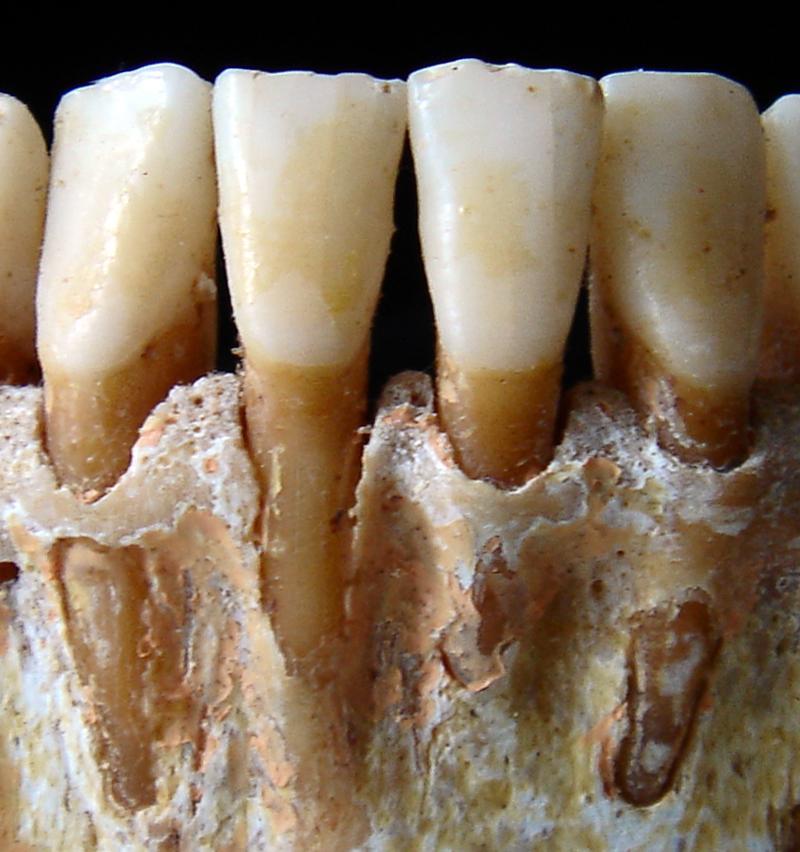 Fenestrações e deiscências são dois defeitos ósseos alveolares freqüentes em grande parte da população (ABDELMALEK