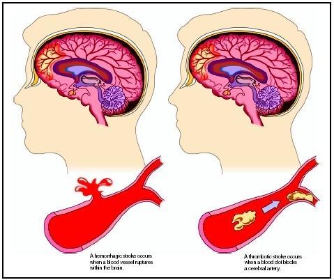 4.3.3 AVC Trombótico Embólico e Lacunar O AVC trombótico é o mais comum (40% dos AVC s) e é causado pela aterosclerose trombose cerebral.