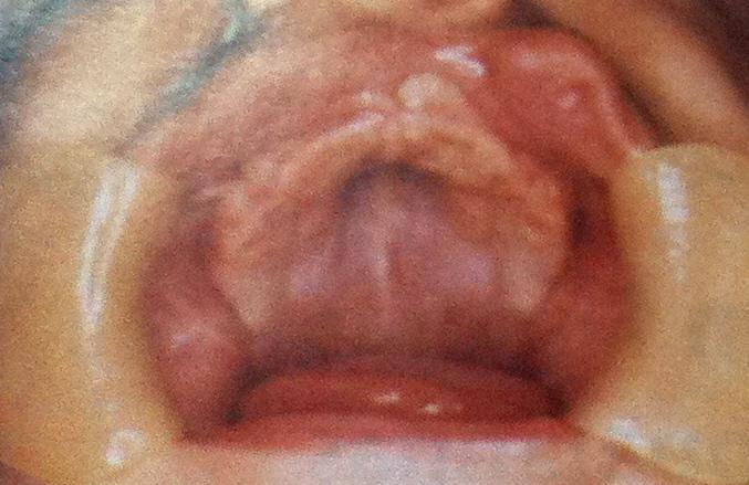 Anomalias dentárias em crianças com fissura palatina ou