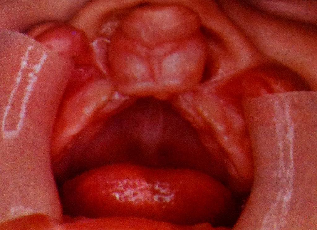 Anomalias dentárias em crianças com fissura palatina ou labial Figura 3a e 3b: Fenda labial e alveolar unilateral completa