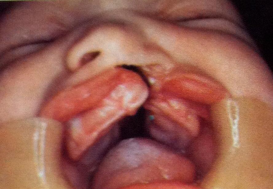 Anomalias dentárias em crianças com fissura palatina ou labial Fig.7 Figura 7: Fenda labial e palatina completa unilateral. Retirada de Machado et al., 2005 Fig.
