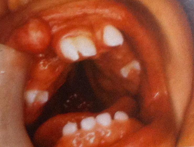 Anomalias dentárias em crianças com fissura palatina ou labial No mesmo estudo, verificou-se que os ICS em forma de pá eram significativamente mais frequentes em indivíduos com FLPU e FLPB, do que