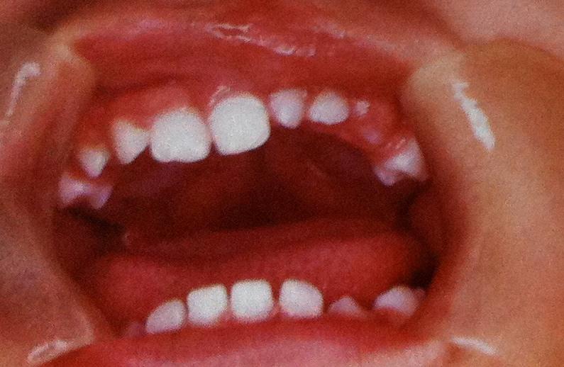 Algumas investigações demonstraram que a existência de um dente supranumerário na dentição decídua, por exemplo um incisivo, tem grandes probabilidades de vir a desenvolver um incisivo supranumerário