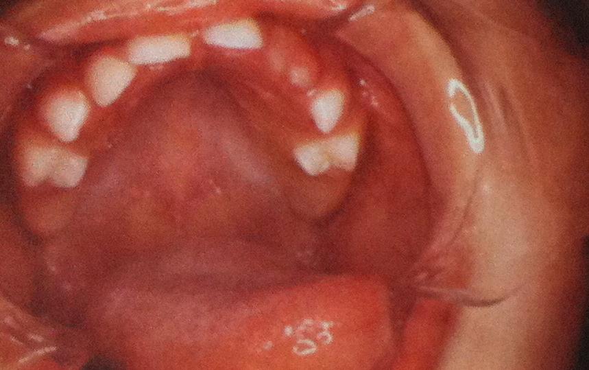 Anomalias dentárias em crianças com fissura palatina ou labial Nesse mesmo estudo, crianças com FLPU, apresentaram desenvolvimento dentário assimétrico ao nível dos dentes anteriores maxilares (Lai