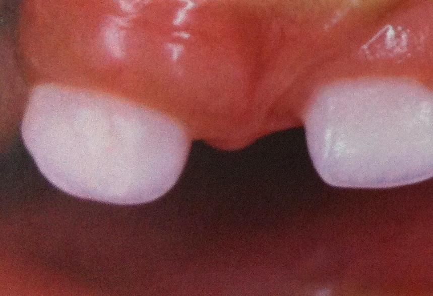 Anomalias dentárias em crianças com fissura palatina ou labial Segundo o estudo realizado por Gomes et al.