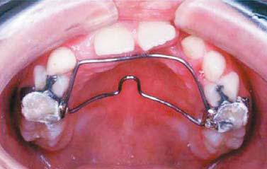 O ortodontista deve sempre confirmar a função oclusal, de modo que o tratamento termine com uma oclusão estável, e proporcione condições para a longevidade dentária e saúde dos tecidos periodontais.