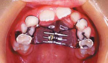 20) Os pacientes continuam a ser acompanhados pelo ortodontista durante 3 a 5 anos após a remoção do aparelho.