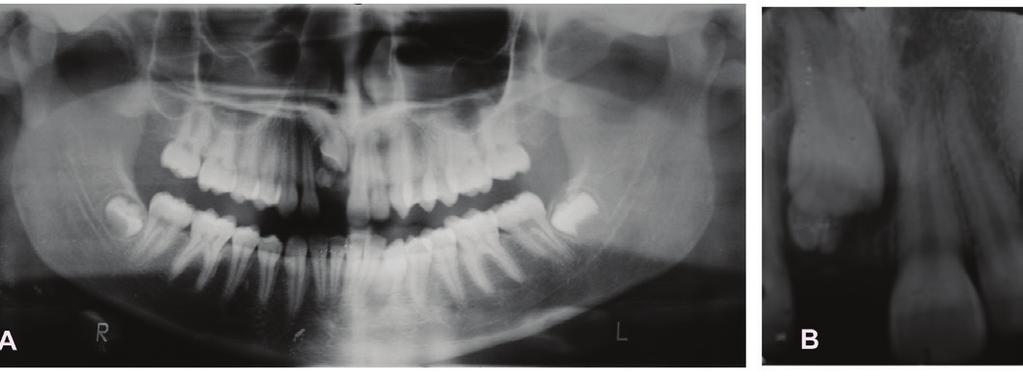 A Aparelho sem botões colados cujas molas helicoidais foram usadas para reposicionar os dentes adjacentes ao espaço para irrupção do incisivo central superior direito (11).