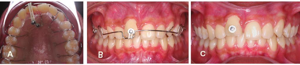 A extremidade externa do fio de amarrilho foi utilizada como apoio para o tracionamento da unidade dentária retida.