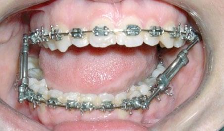 negativo nestes dentes) e os molares inferiores sofrem uma inclinação mesial e uma extrusão.