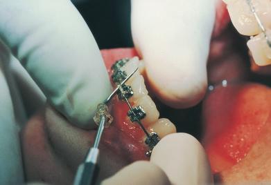 Amagnitude e o intervalo de aplicação de forças podem desencadear processos de reabsorções dentárias distinguem o osso do dente e então destroem tudo», explica o professor de Endodontia.