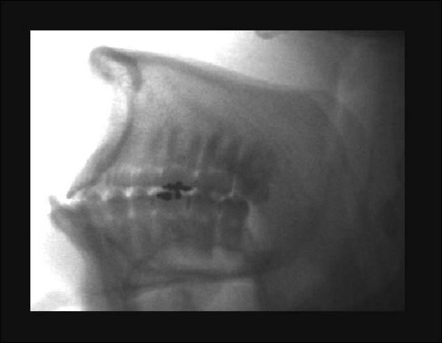 Material e Método 39 representando apenas o slice de 0,3 mm, correspondente ao centro da coroa clínica dos dentes anteriores.