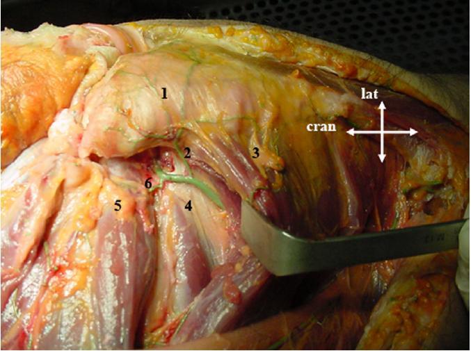 Tönnis 3: quistos subcondrais maiores, diminuição importante da interlinha articular, osteófitos, deformidade grave da cabeça femoral.