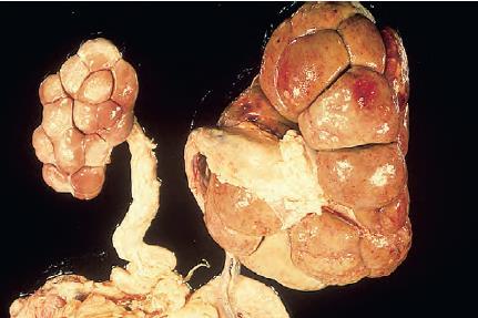 PIELONEFRITE SINAIS CLÍNICOS Flocos de sangue e pús na urina no final da micção Cólica- sinais de desconforto Espessamento e contração da bexiga Ureteres espessados (caneta) à palpação retal