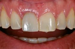 IMPLANTE DENTÁRIO EM INCISIVO CENTRAL VERSUS FACETA DENTÁRIA: TRABALHANDO COM DIFERENTES SUBSTRATOS PASSO A PASSO CLÍNICO tica dos pacientes, seja pela anatomia preexistente dos dentes vizinhos 2 e