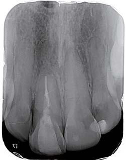 A estética em implantodontia envolve tanto anatomia da coroa sobre implante e o tecido mole circunjacente 3 quanto o tipo de sorriso do paciente, topografia óssea do espaço edêntulo e a relação dos