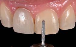 Uma das maiores dificuldades relacionadas à estética, quando se trata de um caso de reabilitação de dentes anteriores, é igualar a cor entre os elementos que receberão trabalhos restauradores