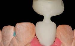 a moldagem, que pôde ser feita em uma única etapa. Moldagem A etapa da moldagem foi uma etapa única para os quatro elementos, que receberiam restaurações distintas. Inicialmente, a coroa em e.