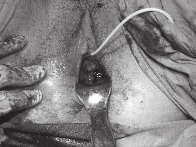 Imagem de Ressonância Magnética da paciente evidenciando Hemi-vagina esquerda preenchida por material hemático (destacado na seta acima). Figura 2.