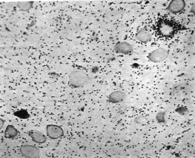 19 Figura 2 Microscopia do corno ventral do 2º segmento medular lombar mostrando uma célula nervosa intacta e uma em neuronofagia subjacente.