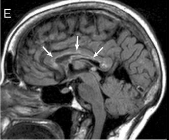 hemisfério cerebral (Figura 5, C e D), lesões extensas no corpo caloso