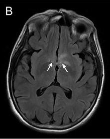 F) (Wingerchuk et al., 2015).