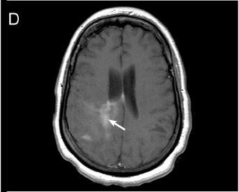 (A), estruturas diencefálicas (B), ou hemisfério cerebral (C e D),