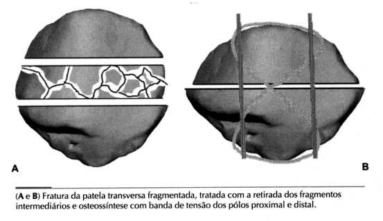 FRATURA