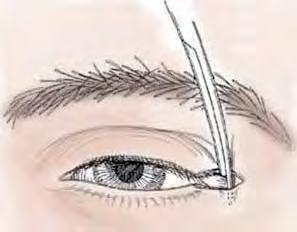 Fig 9 - Excisão pentagonal e sutura directa de defeito palpebral (A-B). Bom resultado funcional e cosmético após 3 meses de seguimento (C).
