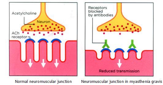 Miastenia gravis O sistema imune produz anticorpos que atacam os receptores musculares, na junção neuromuscular, que recebem impulso nervoso por ação da