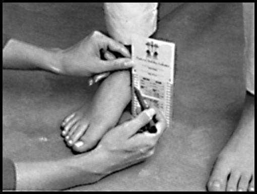 9) Navicular Drop test (desabamento do arco plantar) Este teste é usado para determinar a hiperpronação do pé (ou desabamento do arco plantar).