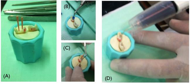 Figura 7: (A) Adaptação do cone principal; (B) corte da guta-percha pelo condutor de calor (C) compactação da guta-percha; (D) injeção de guta-percha termoplastificada com a