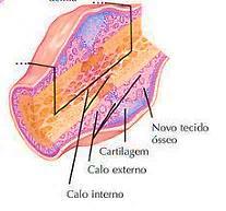 da fratura Novo tecido ósseo e células osteoprogenitoras do calo interno unindo o local de fratura Tecido ósseo se forma em áreas de