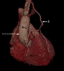 Multidetectores Reconstrução 3D/VR 1. Ponte de Safena Aorta-Coronária direita 2.