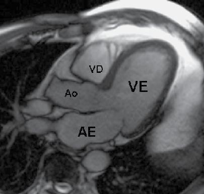 RM Cardíaca AE = Átrio Esquerdo VE = Ventrículo