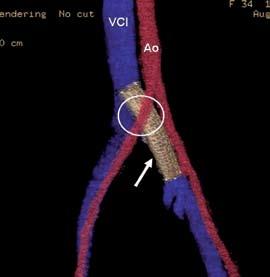 Angio-tomografia para controle pós tratamento com stent