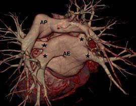 Cruzamento artéria-veia ilíaca Angio-tomografia para