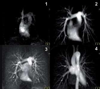 Angio-RM para avaliação da perfusão pulmonar As imagens de