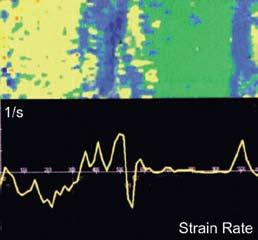 Strain e Strain Rate O strain rate mede, localmente e de forma instantânea, a taxa de compressão ou expansão do miocárdio, independente do movimento de translação cardíaca.