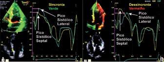 Tissue Synchronization Imaging (TSI) O TSI, mede em cada ponto do miocárdio o tempo decorrido desde o início do complexo QRS até o pico sistólico da onda do Doppler tecidual (time to peak).