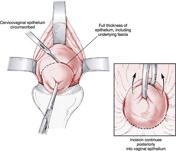 TÉCNICA CIRÚRGICA Exame vaginal sob anestesia Melhor acessibilidade às estruturas anatómicas.