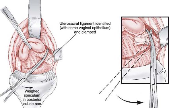 TÉCNICA CIRÚRGICA Corte e laqueação dos ligamentos útero- sagrados Posicionamento do clampe na perpendicular ao eixo do útero;